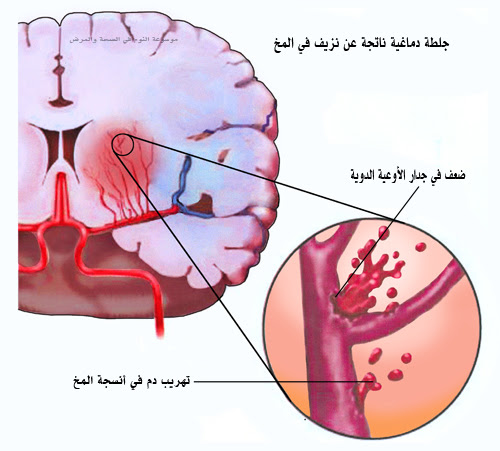 صورة توضيحية لجلطات المخ
